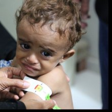  أزمة-إنسانیة - الیونیسف: سوء التغذیة بین الأطفال فی الیمن یصل إلى أعلى مستویاته